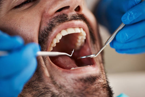 Best Emergency Wisdom Tooth Extraction in Demorest, GA